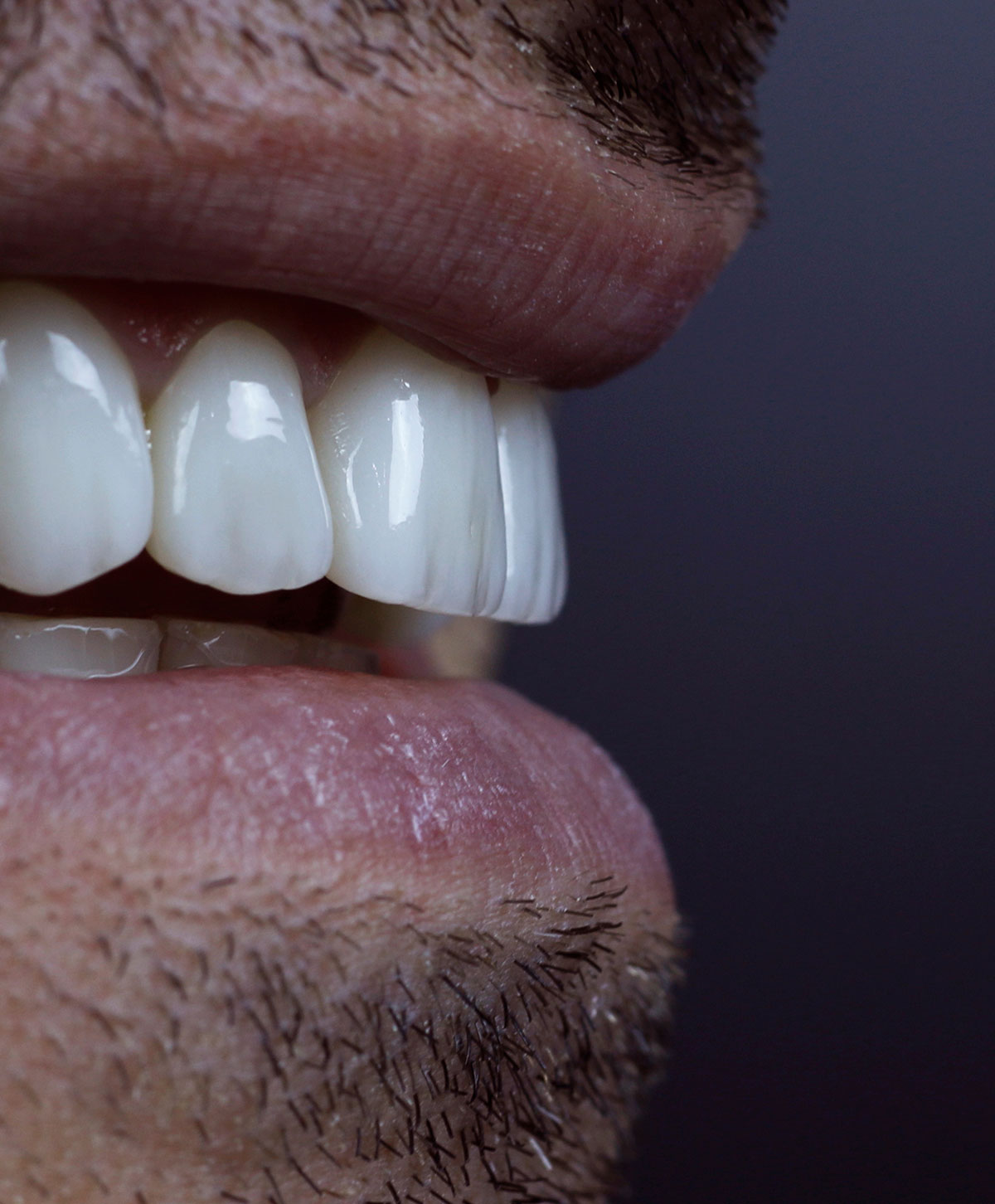 Close Up digitale di un sorriso per futura applicazione di protesi dentali