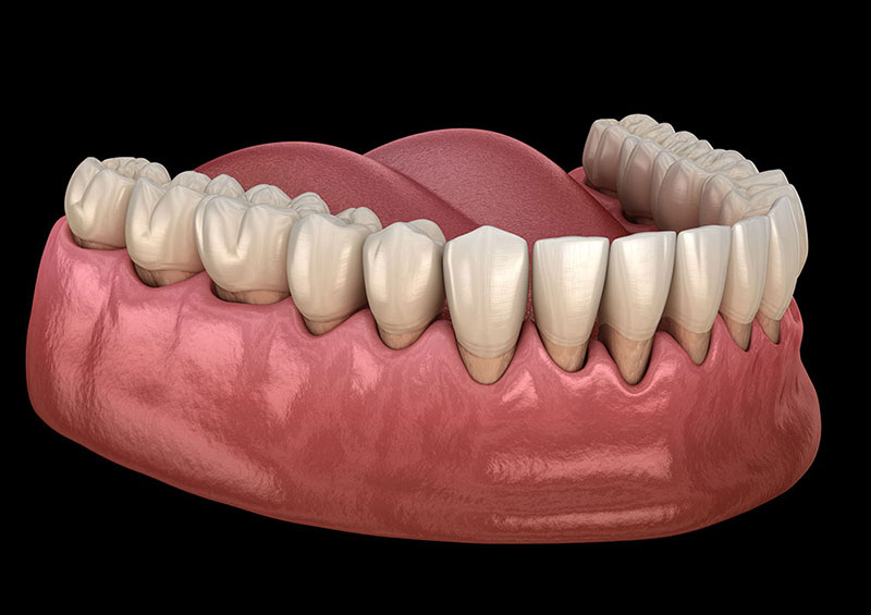 Render 3D bocca con parodontite